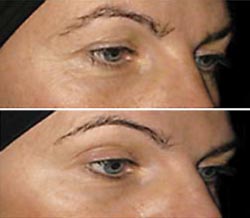 Collagen peptides help reduce eye wrinkles 