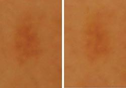 Vitamin C derivative protects skin and combats UV damage