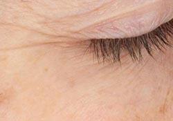 Skin tightening boosted in anti-ageing applications