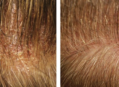 The effect of Nordic seed oil on dry, irritated scalp 