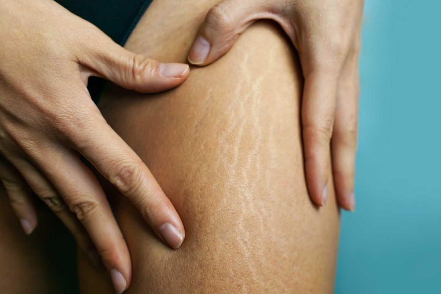 Givaudan gets active on stretch marks