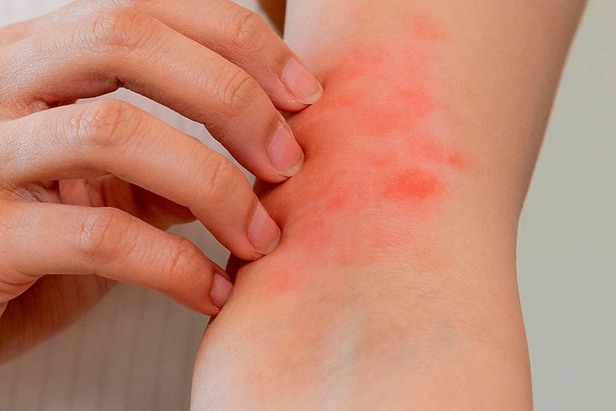 MyMicrobiome unveils eczema-prone skin product standard
