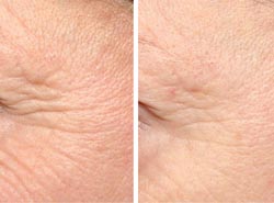 Wrinkles visibly smoother