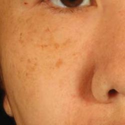 Age spots: causes and treatments